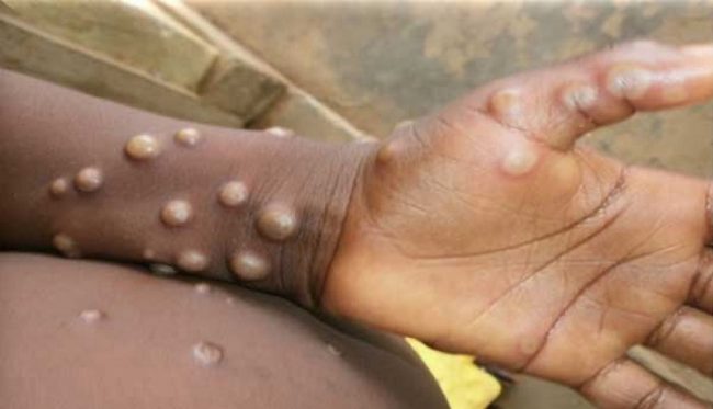 Is the next pandemic monkeypox? WHO will surely respond soon?